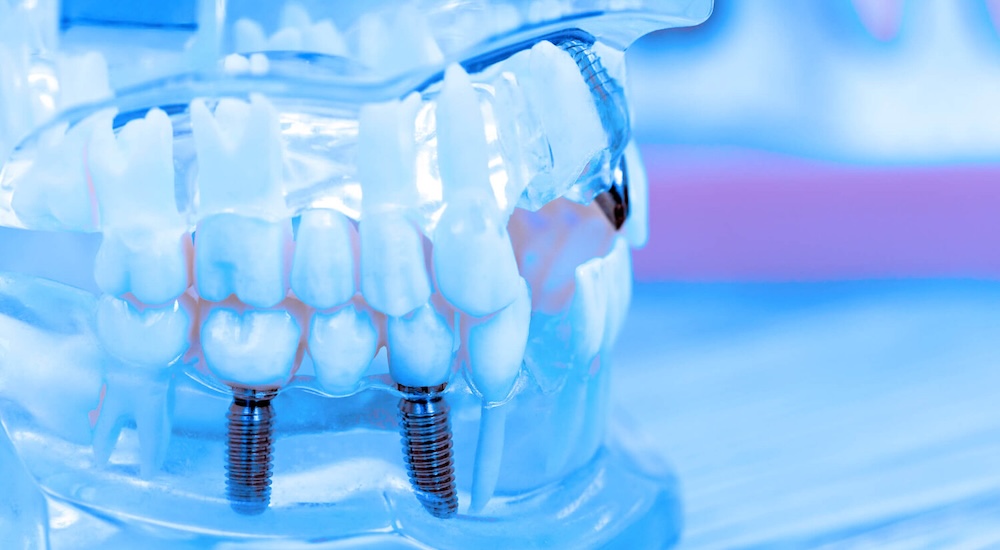 Dental Implants in Indialantic, FL